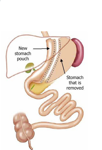 Aspen Post Gastrectomy Diets